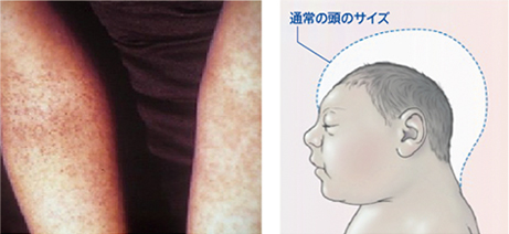 （左）図3 デング熱患者で認められる皮下出血　（右）図4 先天性ジカウイルス感染症で認められる小頭症