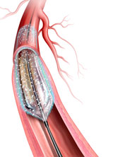 下肢末梢動脈疾患の再狭窄を抑制する、 「Lutonix® ドラッグ