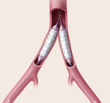 図2. 腸骨動脈におけるKissing Stent留置イメージ