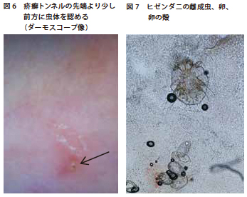 は 疥癬 と