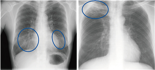（左）図1　結節気管支拡張型肺MAC症 （右）図2　線維空洞型肺MAC症